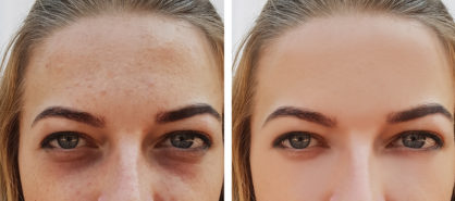 mezoterapiya lica do i posle foto