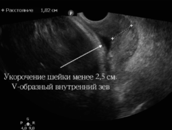 Зев закрыт при беременности. Истмико-цервикальная недостаточность на УЗИ. УЗИ шейки матки цервикометрия. Ультразвуковые критерии ИЦН.