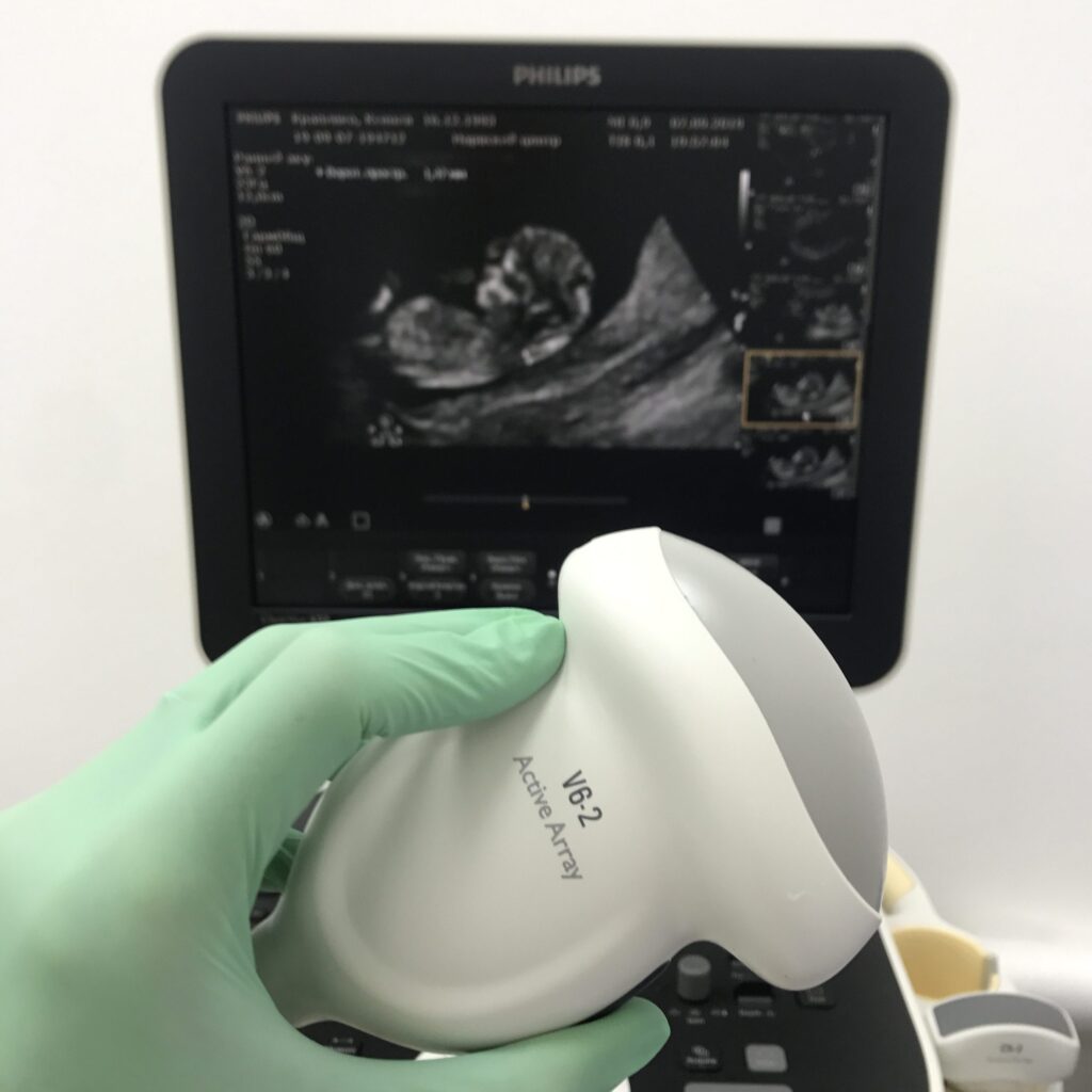 УЗИ при многоплодной беременности 3D и 4D
