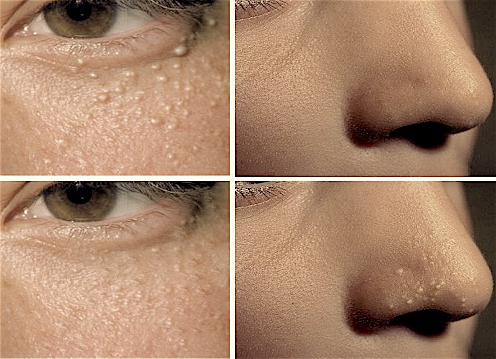 Милиумы на лице: как избавиться от белых точек на коже в домашних условиях